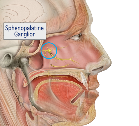 Sphenopalatine Ganglion Block for Migraine & Headache Relief